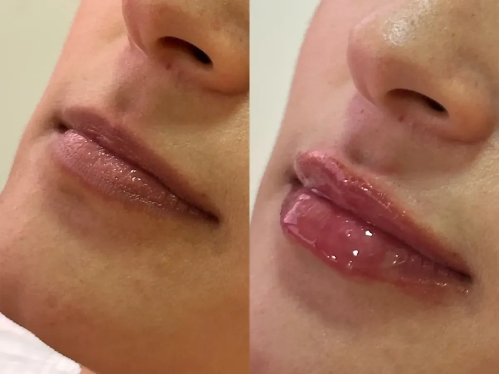 Diseño de labios - Grupo Estético CB Colombia