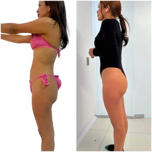 Gluteoplastia - Grupo Estético CB Colombia